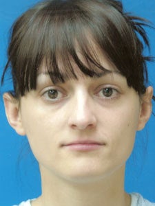 Otoplasty Ear Surgery - Female before 818044