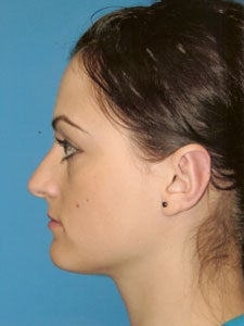 Otoplasty Ear Surgery - Female 818044