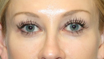 Latisse after 934863