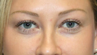 Latisse before 934863