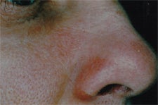 Facial vessels in adults after 829107