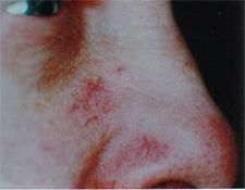Facial vessels in adults before 829107