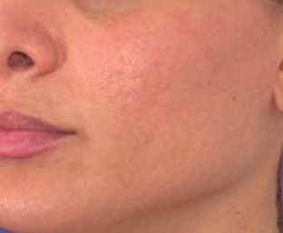 Mesotherapy after 920811