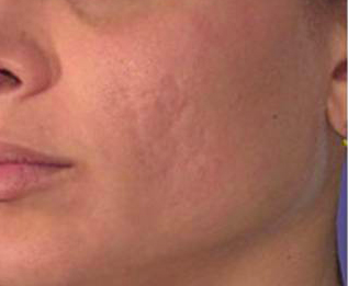 Mesotherapy before 920811