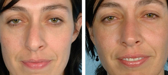 Functional Rhinoplasty before 1208316