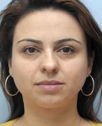 Facial Dermafillers 1001784