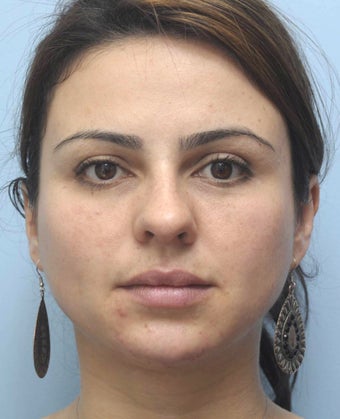 Facial Dermafillers 1001784