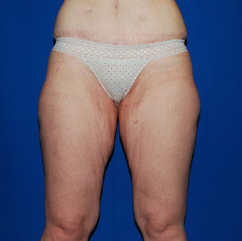 Thigh Lift before 945347