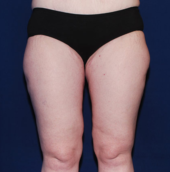 Thigh Lift after 945347