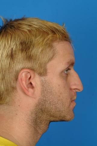 33 year old male who wanted to improve his breathing, less of a hump and droopy tip, but he wanted to have masculine nose. before 932285