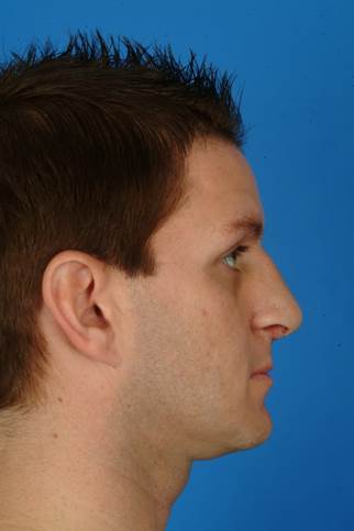 33 year old male who wanted to improve his breathing, less of a hump and droopy tip, but he wanted to have masculine nose. after 932285