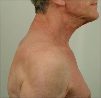 Buffalo Hump Reduction 491522