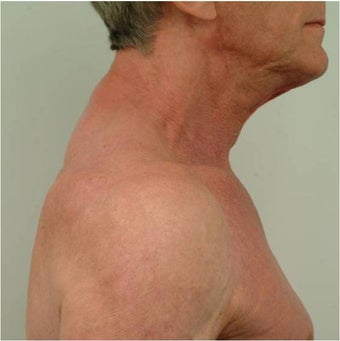 Buffalo Hump Reduction 491522