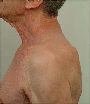 Buffalo Hump Reduction after 491522