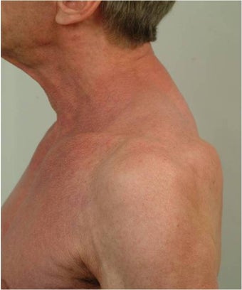 Buffalo Hump Reduction before 491522
