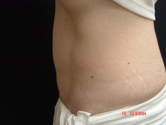 Coolsculpting Abdomen 355462