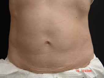 Coolsculpting Abdomen after 355462