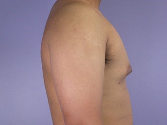 Male Breast Reduction after 285186
