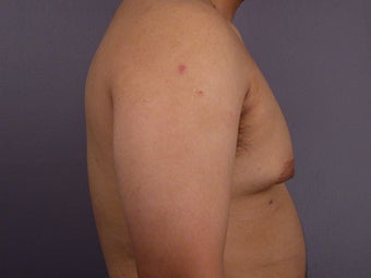Male Breast Reduction before 285186