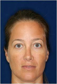 Non Surgical Rhinoplasty after 798621