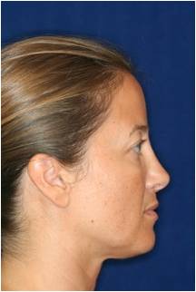 Non Surgical Rhinoplasty 798621