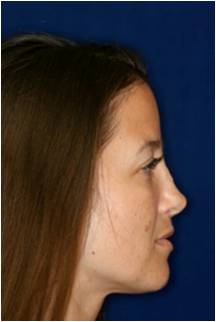 Non Surgical Rhinoplasty 798621