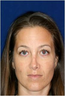 Non Surgical Rhinoplasty before 798621