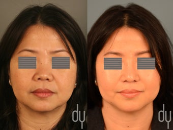 Asian rhinoplasty with rib cartilage harvest, and dorsal augmentation with diced cartilage fascia (DCF). before 1310280
