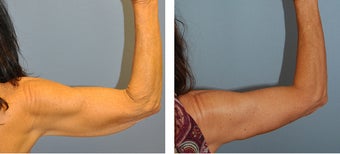 Smart Lipo Arm Lift before 1153907