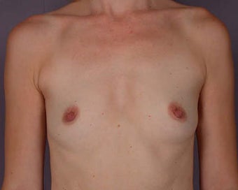 Breast Augmentation before 281426