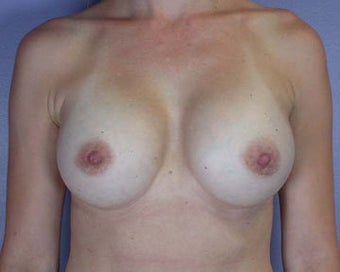 Breast Augmentation after 281426