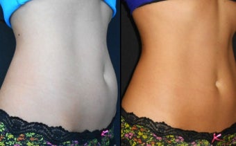 Coolsculpting before 1102830