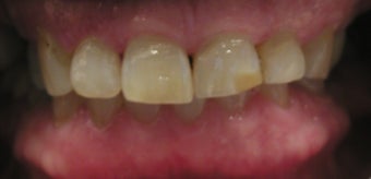 Full Mouth Reconstruction with Porcelain Crowns and Veneers before 889508