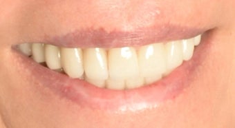 Full Mouth Reconstruction with Porcelain Crowns and Veneers after 889508