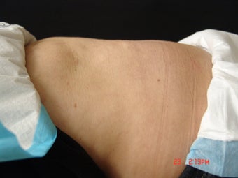 Coolsculpting Lower Abdomen after 329795