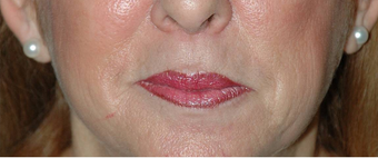 Lip Augmentation with Lip Lift for Natural, Refreshed Look after 896346