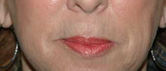 Lip Augmentation with Lip Lift for Natural, Refreshed Look before 896346