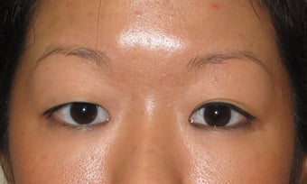 Asian Blepharoplasty before 326041