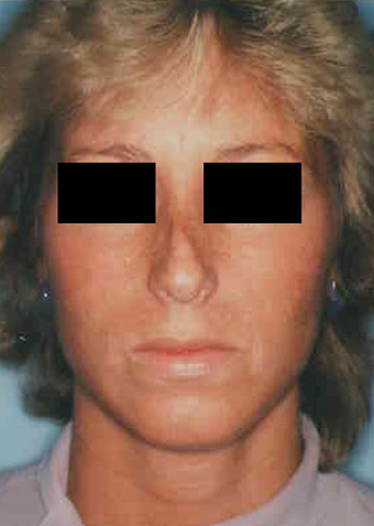 Revision Rhinoplasty before 665084