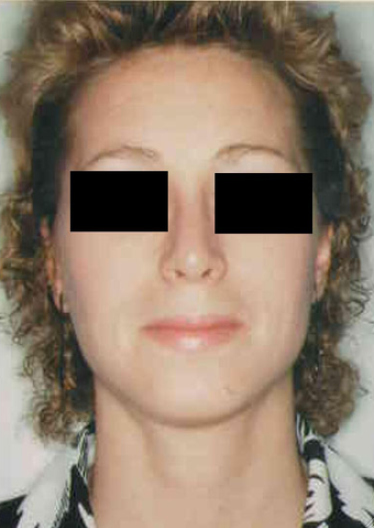 Revision Rhinoplasty after 665084
