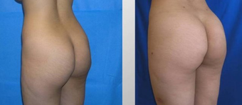 Butt Augmentation before 256433