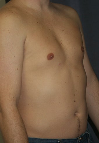 Liposuction of the male chest and abdomen after 243342
