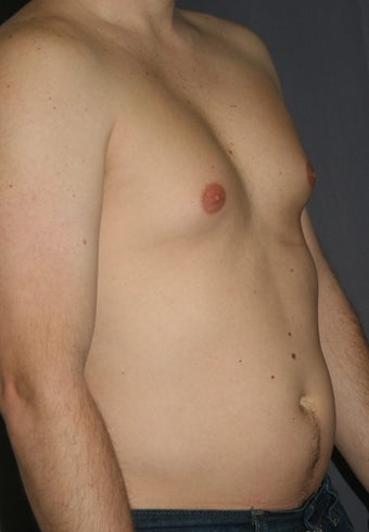 Liposuction of the male chest and abdomen before 243342