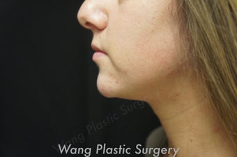Chin Augmentation with Radiesse filler after 693342