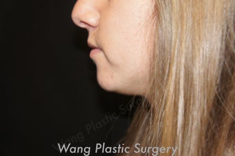 Chin Augmentation with Radiesse filler before 693342
