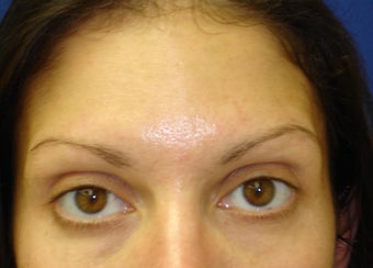 Forehead Lines after 837764