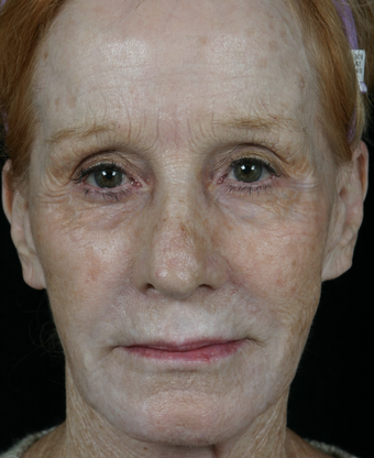Pearl Fractional before 302237