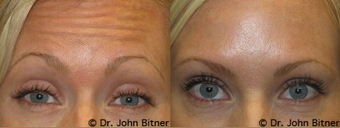 Botox before 1156435