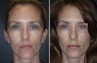 Juvederm before 178359