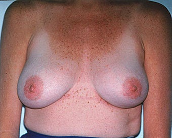 Breast Asymmetry Correction after 281313